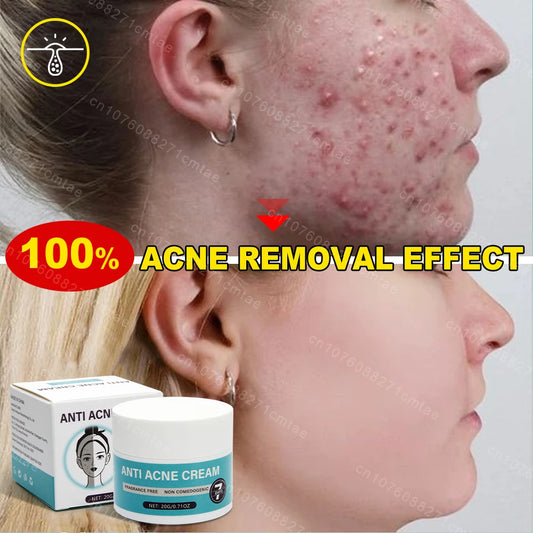 Acne Treatment Repair Acne Marks Deep Cleansing Shrink Pores Moisturizing Skin Care Products