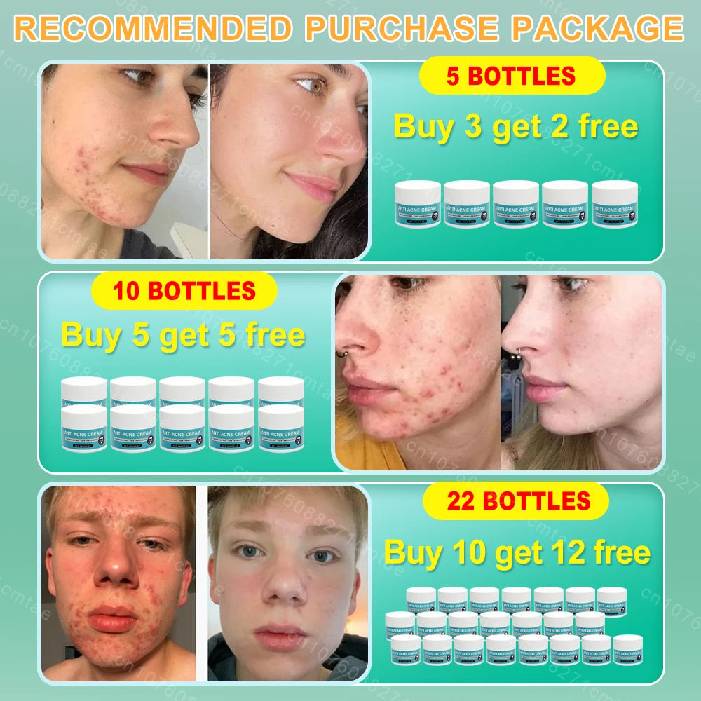 Acne Treatment Repair Acne Marks Deep Cleansing Shrink Pores Moisturizing Skin Care Products