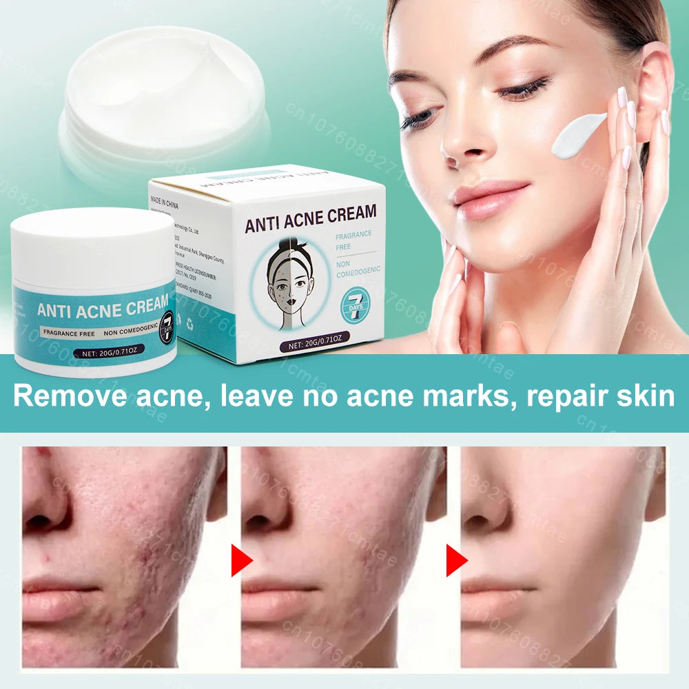 Acne Treatment Repair Acne Marks Deep Cleansing Shrink Pores Moisturizing Skin Care Products